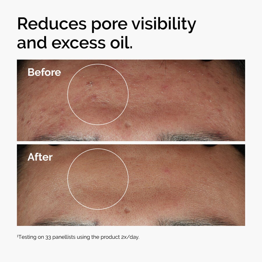 https://theordinary.com/dw/image/v2/BFKJ_PRD/on/demandware.static/-/Sites-deciem-master/default/dwcf135ad6/Images/products/The%20Ordinary/Before-After/ord-niacinamide-zinc-blemish-serum-before-after-pores.jpg?sw=900&sh=900&sm=fit